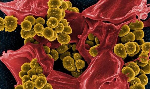 Staphylococcus aureus comme cause de prostatite bactérienne