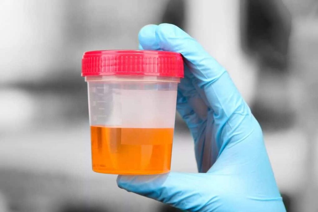 urine avec du sang dans la prostatite calculeuse