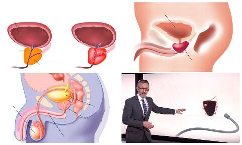 prostate saine et malade